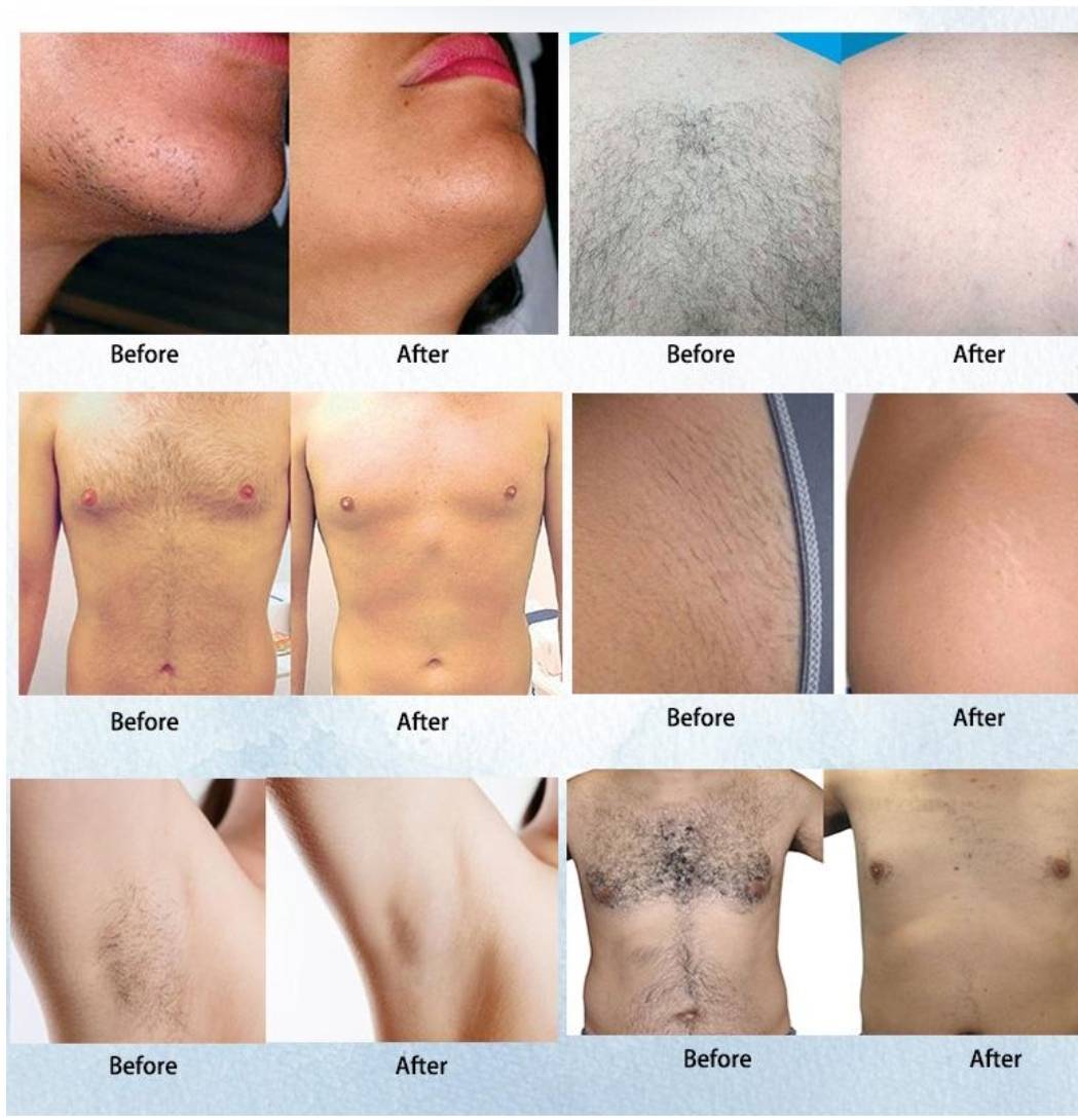 Diode Laser Germany bars 808 เครื่องกำจัดขนไดโอดเลเซอร์ 2022