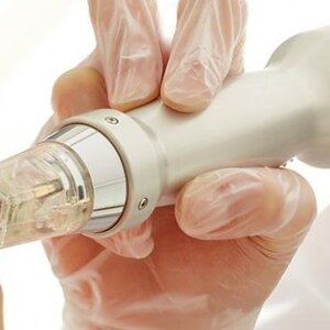 การรักษาหลุมสิวด้วย RF Micro-needle หรือที่เรียกว่า Fractional RF