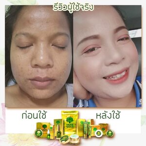 รีวิวลูกค้าที่เป็นสิว